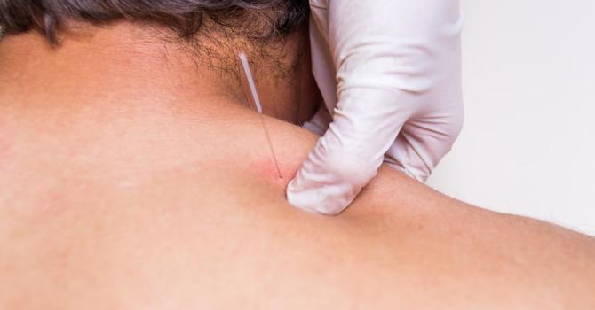 Healing Precision: The Synergy of Chiropractic Care and Dry Needling Therapy  image