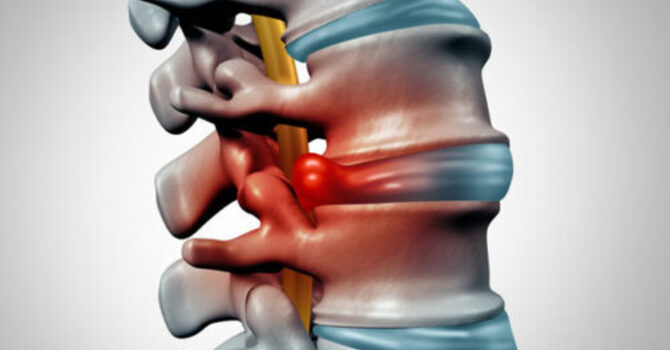 TREATING A BULGING DISC image
