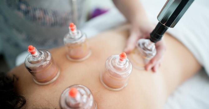 WHAT IS CUPPING THERAPY image
